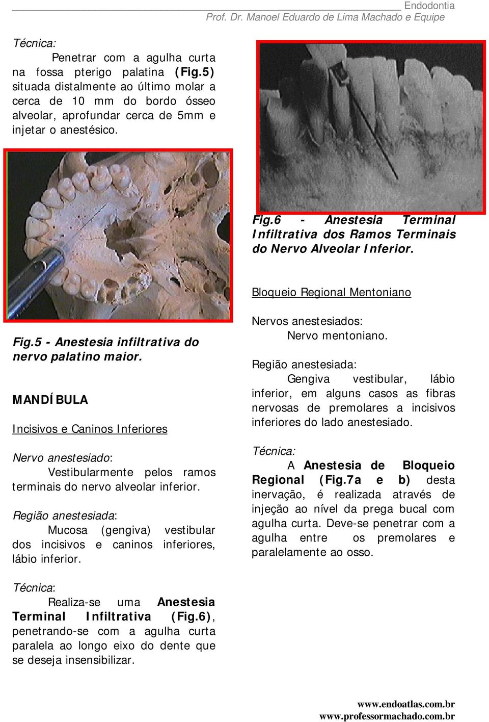 MANDÍBULA Incisivos e Caninos Inferiores Vestibularmente pelos ramos terminais do nervo alveolar inferior. Mucosa (gengiva) vestibular dos incisivos e caninos inferiores, lábio inferior.