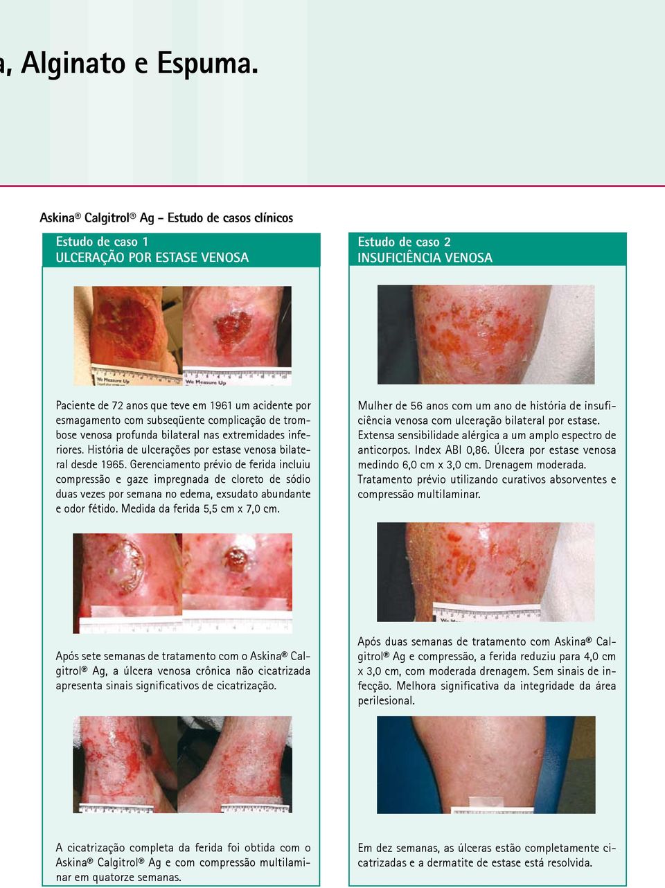 subseqüente complicação de trombose venosa profunda bilateral nas extremidades inferiores. História de ulcerações por estase venosa bilateral desde 1965.