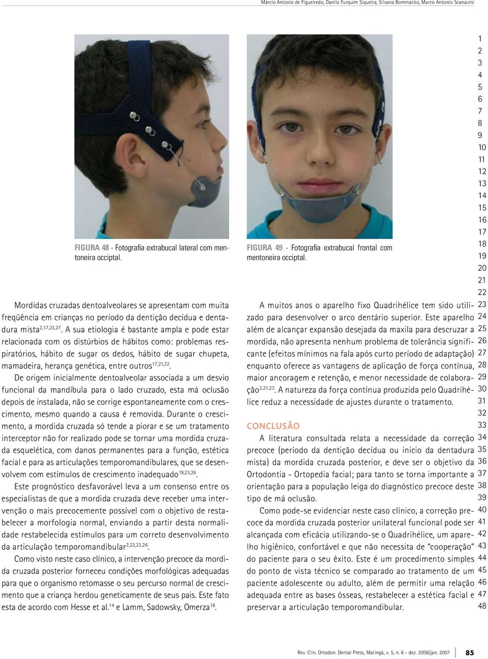 A sua etiologia é bastante ampla e pode estar relacionada com os distúrbios de hábitos como: problemas respiratórios, hábito de sugar os dedos, hábito de sugar chupeta, mamadeira, herança genética,