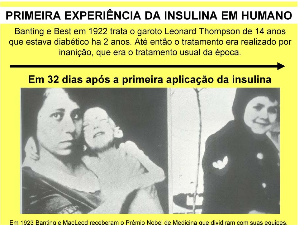 PRIMEIRA EXPERIÊNCIA DA INSULINA EM HUMANO Banting e Best em 1922 trata o garoto Leonard