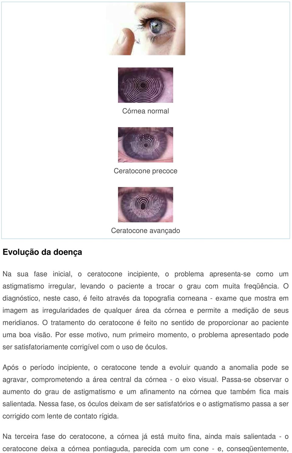 O diagnóstico, neste caso, é feito através da topografia corneana - exame que mostra em imagem as irregularidades de qualquer área da córnea e permite a medição de seus meridianos.