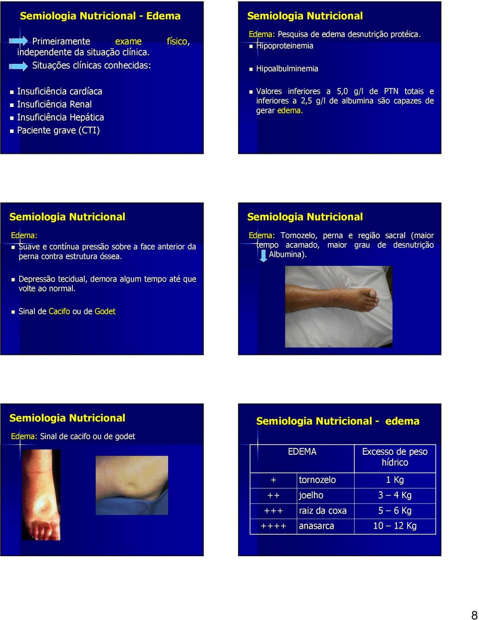 Hipoproteinemia Hipoalbulminemia Valores inferiores a 5,0 g/l de PTN totais e inferiores a 2,5 g/l de albumina são capazes de gerar edema.