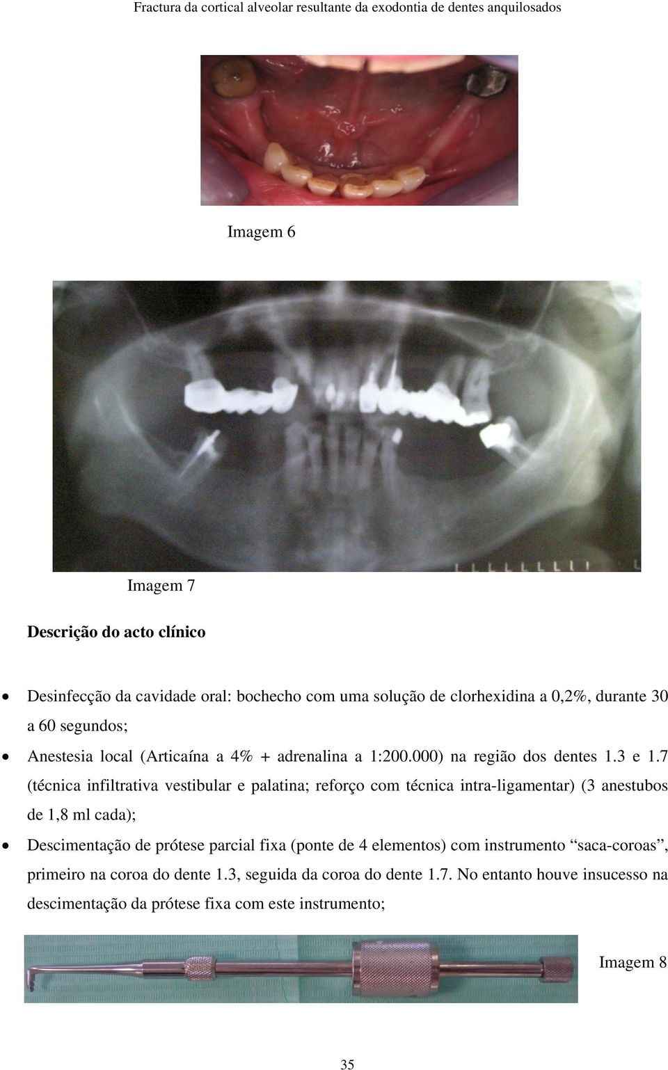 7 (técnica infiltrativa vestibular e palatina; reforço com técnica intra-ligamentar) (3 anestubos de 1,8 ml cada); Descimentação de prótese parcial