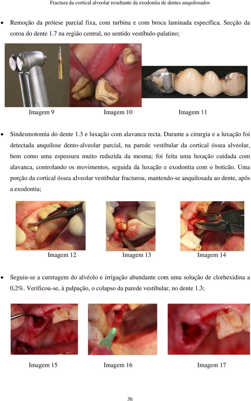 Durante a cirurgia e a luxação foi detectada anquilose dento-alveolar parcial, na parede vestibular da cortical óssea alveolar, bem como uma espessura muito reduzida da mesma; foi feita uma luxação