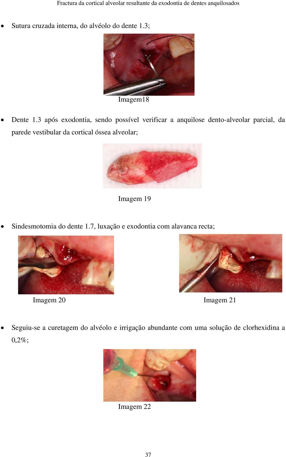 da cortical óssea alveolar; Imagem 19 Sindesmotomia do dente 1.