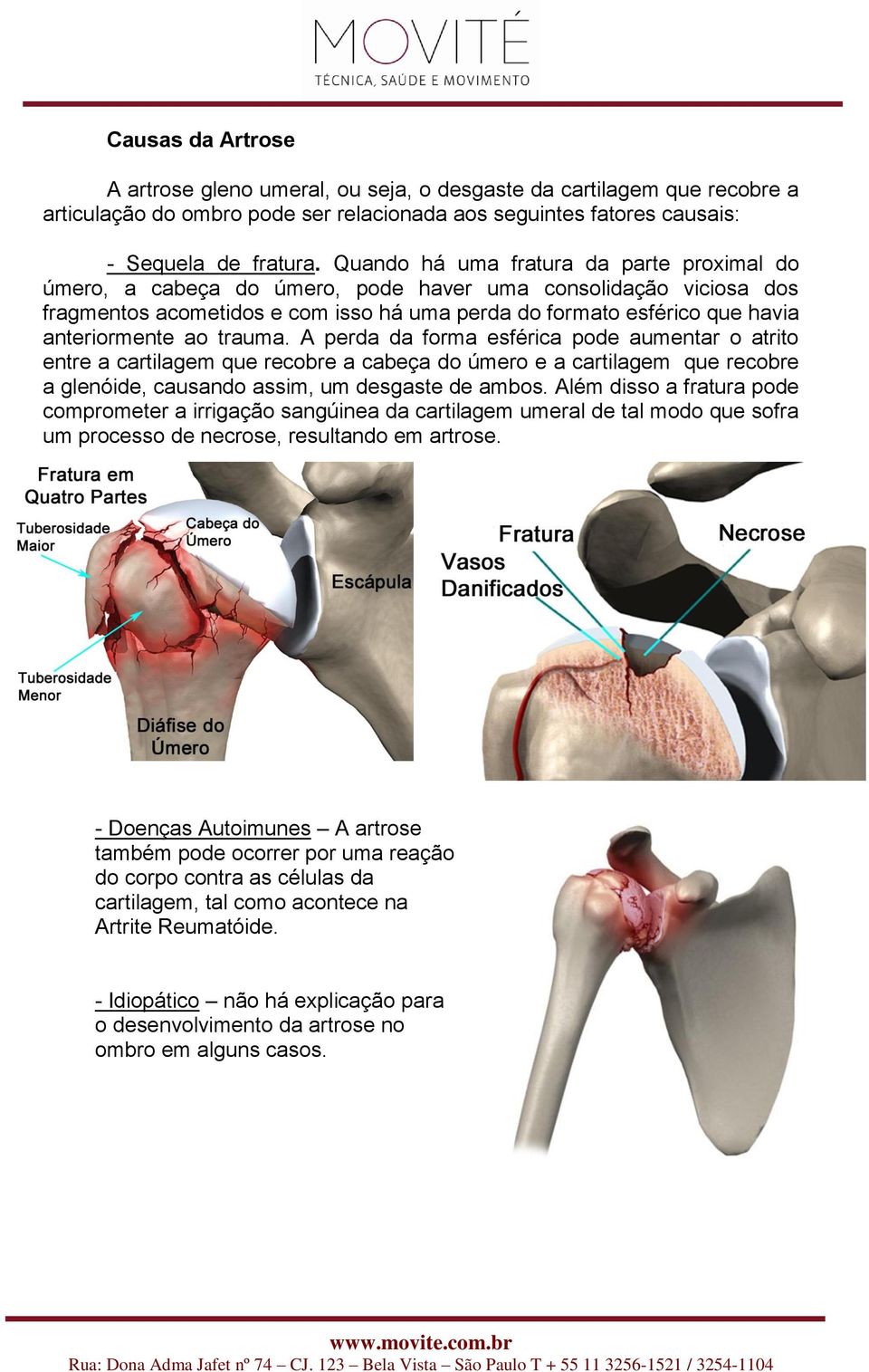 ao trauma. A perda da forma esférica pode aumentar o atrito entre a cartilagem que recobre a cabeça do úmero e a cartilagem que recobre a glenóide, causando assim, um desgaste de ambos.