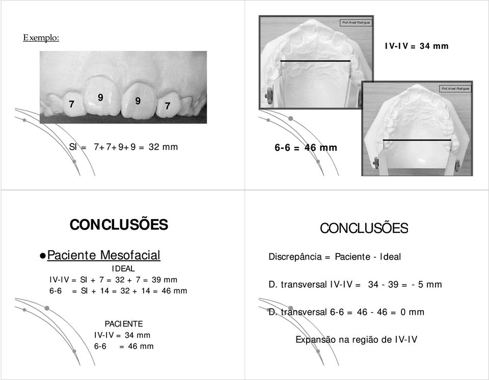 SI + 7 = 32 + 7 = 39 mm 6-66 = SI + 14 = 32 + 14 = 46 mm PACIENTE IV-IV = 34 mm 6-66 = 46 mm