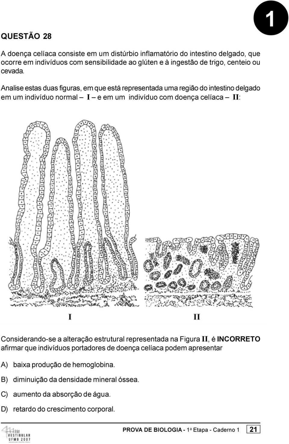 Analise estas duas figuras, em que está representada uma região do intestino delgado em um indivíduo normal I e em um indivíduo com doença celíaca II: