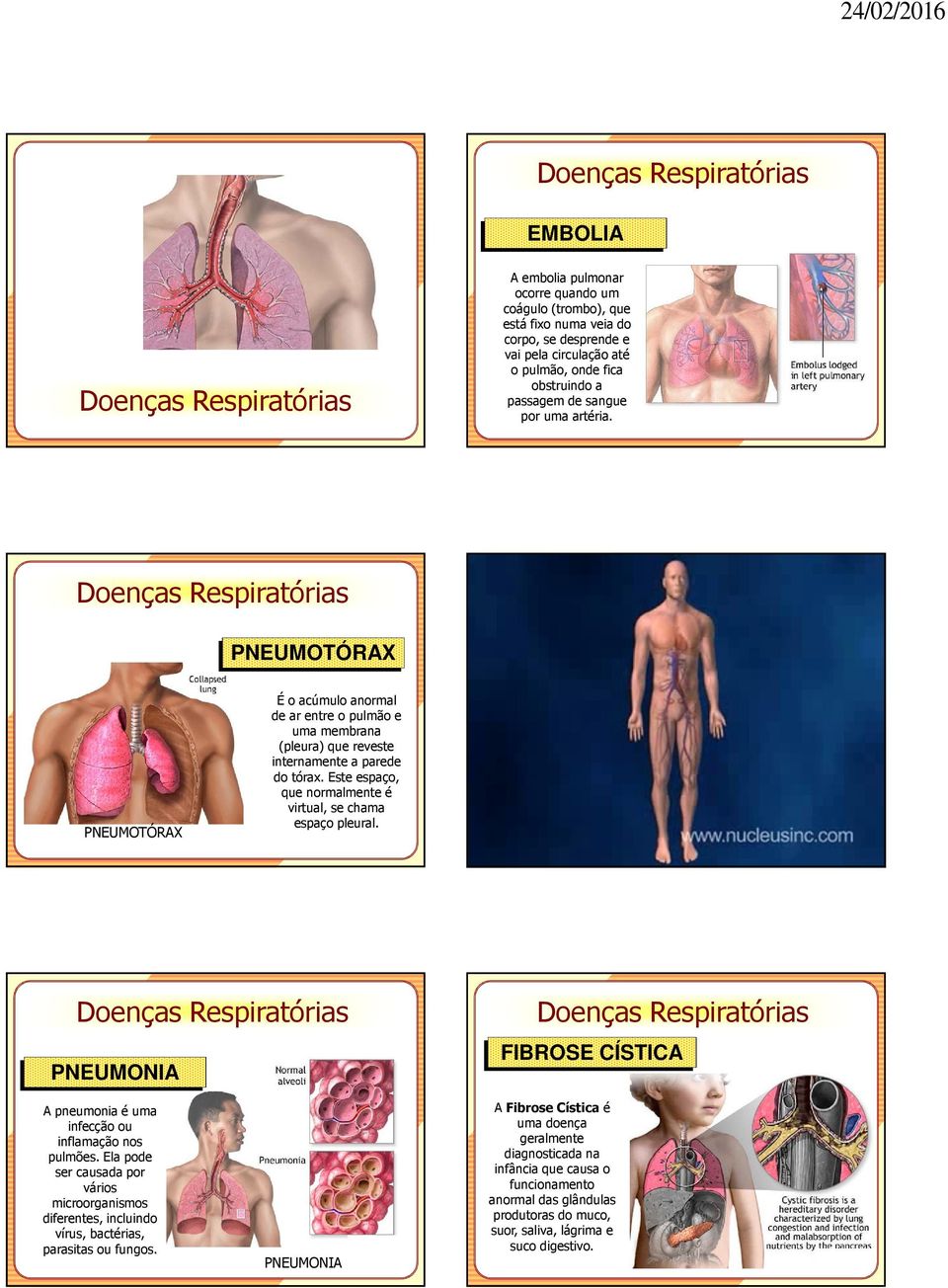 Doenças Respiratórias PNEUMOTÓRAX PNEUMOTÓRAX É o acúmulo anormal de ar entre o pulmão e uma membrana (pleura) que reveste internamente a parede do tórax.
