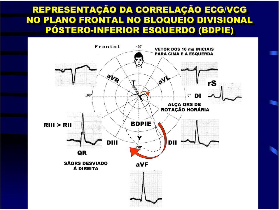 INICIAIS PARA CIMA E Á ESQUERDA avr T avl rs DI ALÇA QRS DE