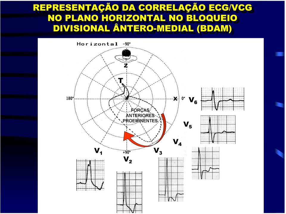 ÂNTERO-MEDIAL (BDAM) T Z X V 6 FORÇAS