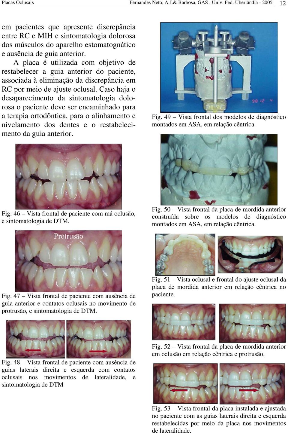 A placa é utilizada com objetivo de restabelecer a guia anterior do paciente, associada à eliminação da discrepância em RC por meio de ajuste oclusal.