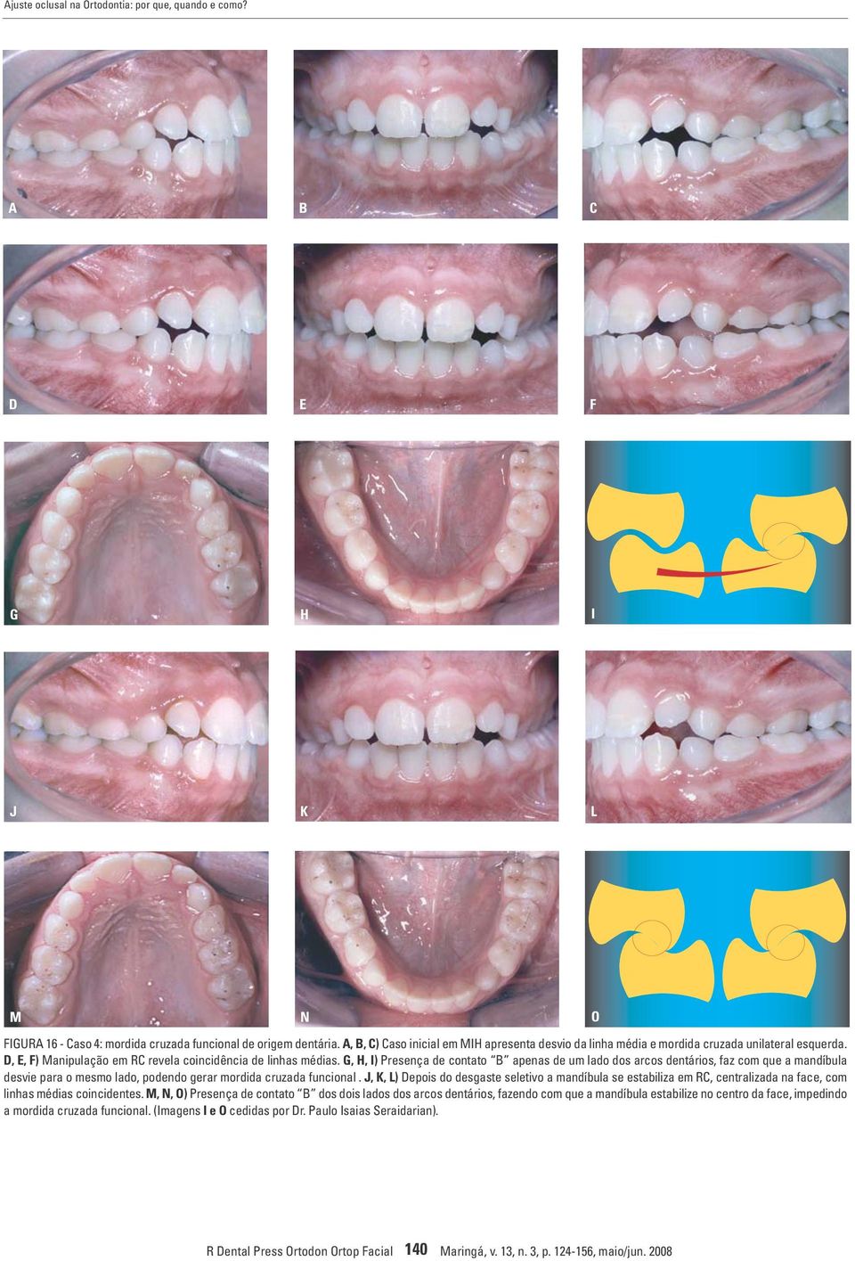 G, H, I) Presença de contato B apenas de um lado dos arcos dentários, faz com que a mandíbula desvie para o mesmo lado, podendo gerar mordida cruzada funcional.