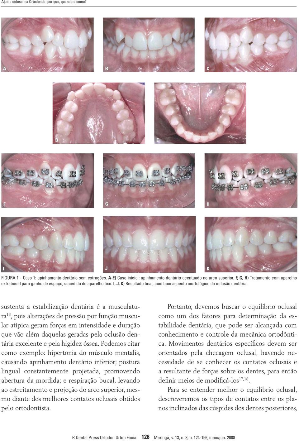 K sustenta a estabilização dentária é a musculatura 13, pois alterações de pressão por função muscular atípica geram forças em intensidade e duração que vão além daquelas geradas pela oclusão