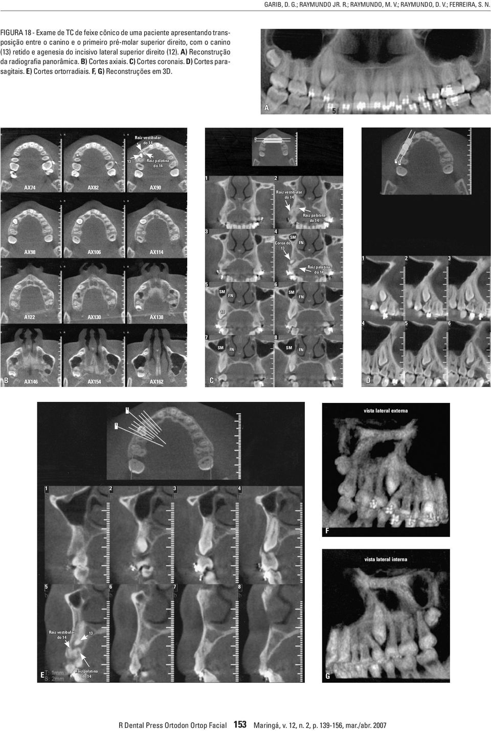 superior direito (12). A) Reconstrução da radiografia panorâmica. B) Cortes axiais. C) Cortes coronais. D) Cortes parasagitais. E) Cortes ortorradiais. F, G) Reconstruções em 3D.