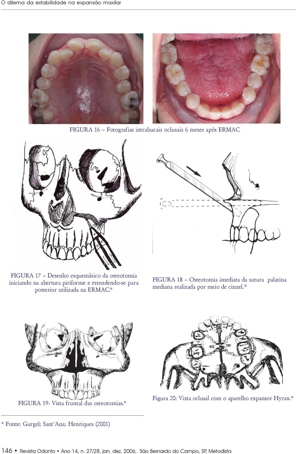 * FIGURA 18 Osteotomia imediata da sutura palatina mediana realizada por meio de cinzel.