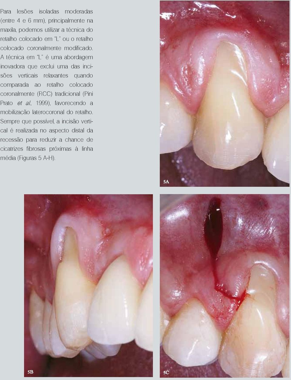 A técnica em L é uma abordagem inovadora que exclui uma das incisões verticais relaxantes quando comparada ao retalho colocado coronalmente (RCC)