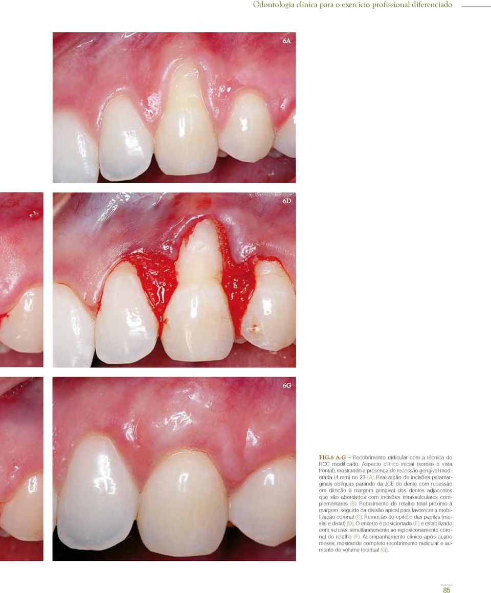 Realização de incisões paramarginais oblíquas partindo da JCE do dente com recessão em direção à margem gengival dos dentes adjacentes que são abordados com incisões intrassulculares complementares