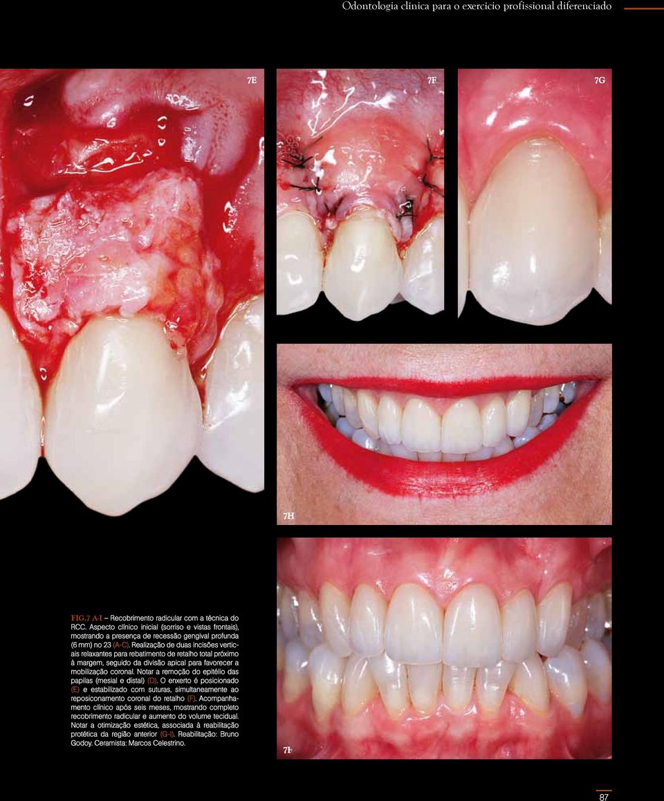 Realização de duas incisões verticais relaxantes para rebatimento de retalho total próximo à margem, seguido da divisão apical para favorecer a mobilização coronal.