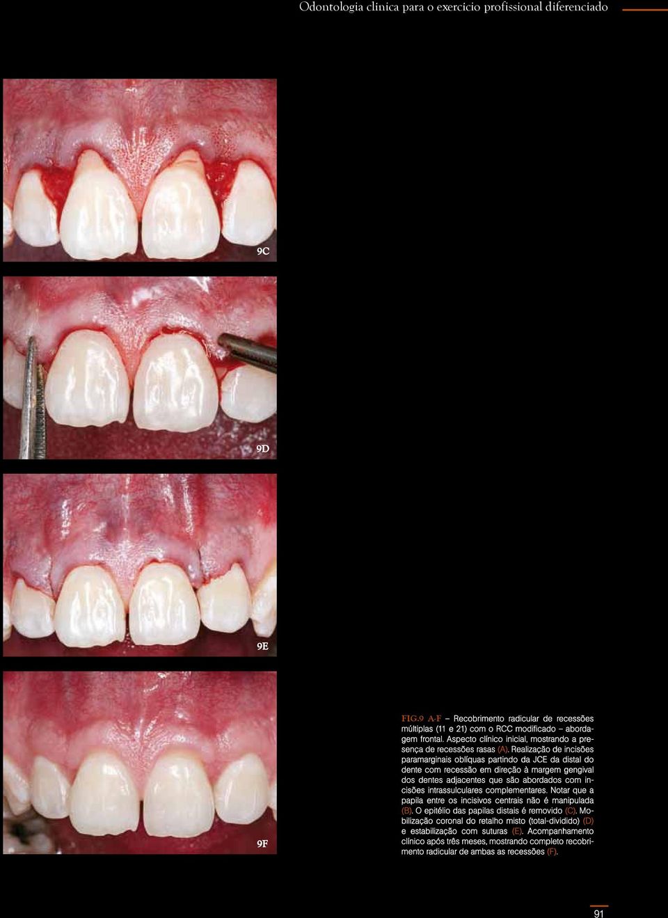 Realização de incisões paramarginais oblíquas partindo da JCE da distal do dente com recessão em direção à margem gengival dos dentes adjacentes que são abordados com incisões intrassulculares