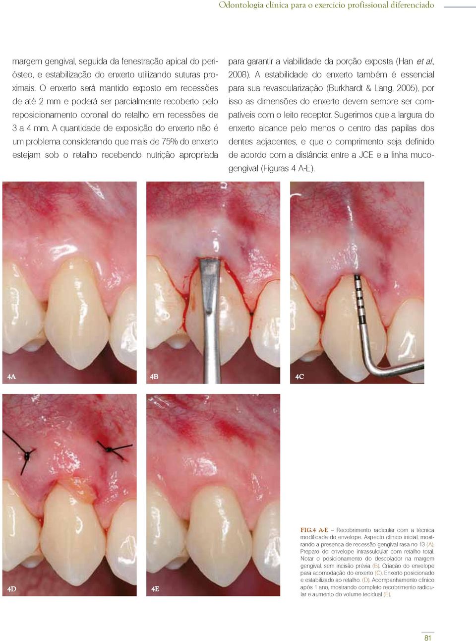 A quantidade de exposição do enxerto não é um problema considerando que mais de 75% do enxerto estejam sob o retalho recebendo nutrição apropriada para garantir a viabilidade da porção exposta (Han