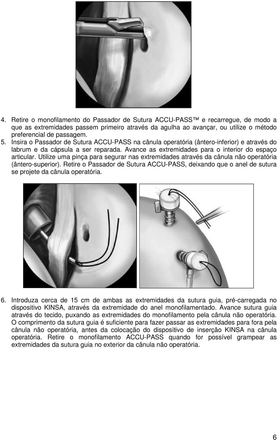 Utilize uma pinça para segurar nas extremidades através da cânula não operatória (ântero-superior).