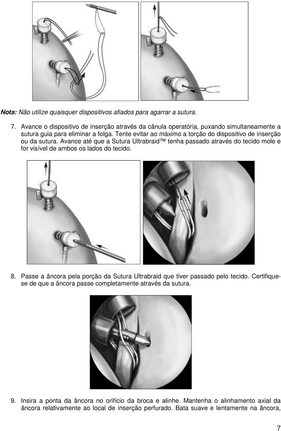 Tente evitar ao máximo a torção do dispositivo de inserção ou da sutura.