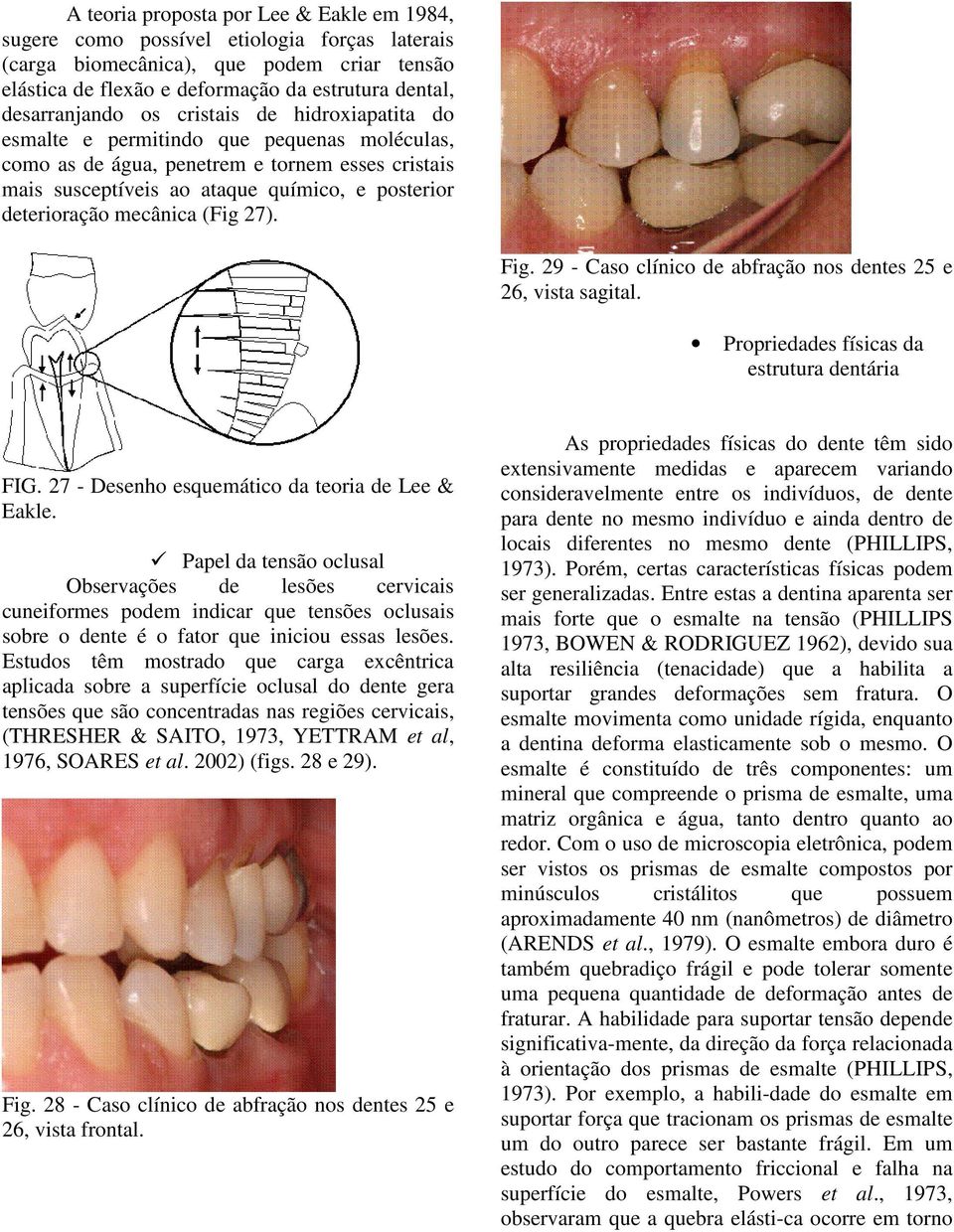 deterioração mecânica (Fig 27). Fig. 29 - Caso clínico de abfração nos dentes 25 e 26, vista sagital. Propriedades físicas da estrutura dentária FIG. 27 - Desenho esquemático da teoria de Lee & Eakle.