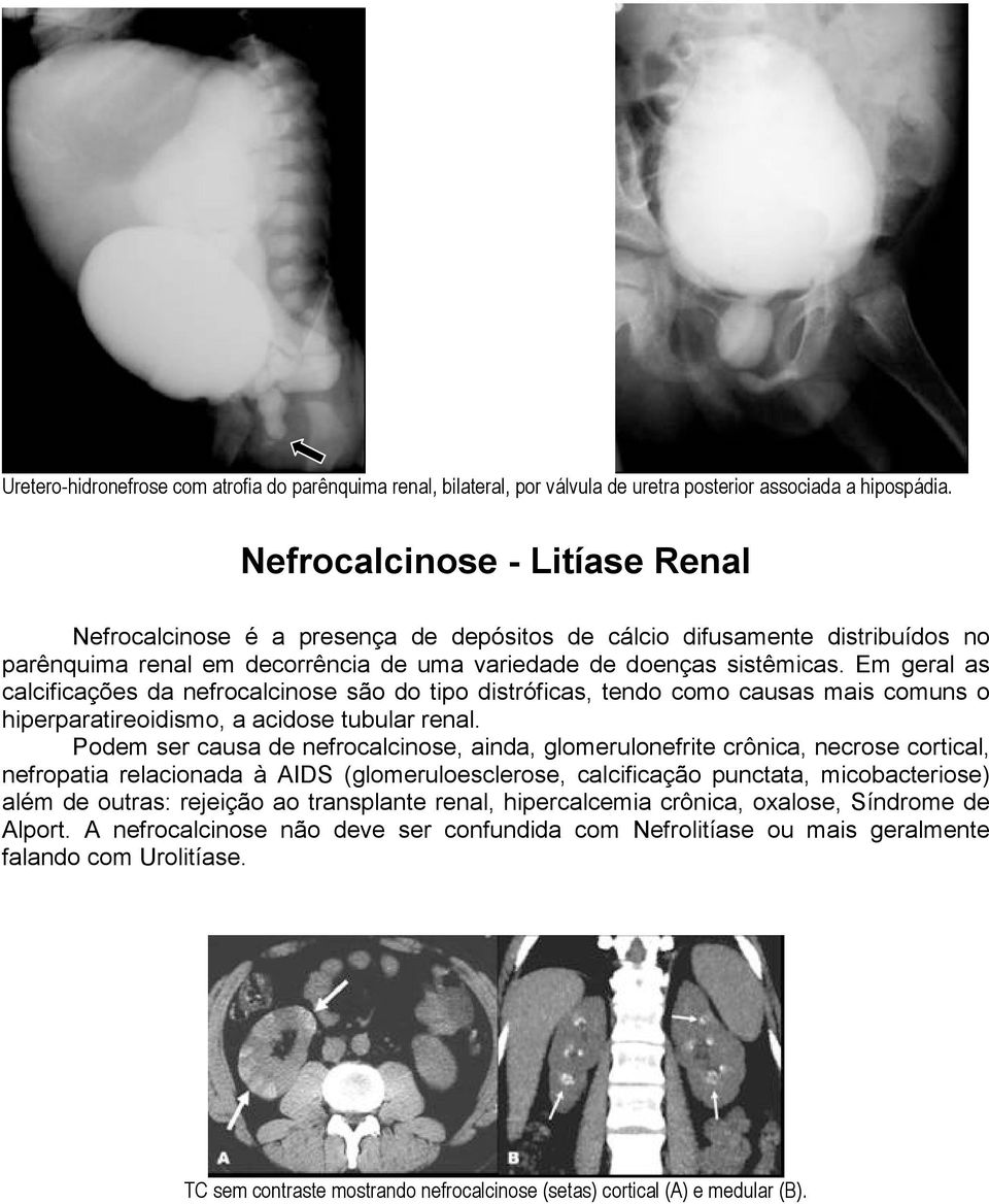 Em geral as calcificações da nefrocalcinose são do tipo distróficas, tendo como causas mais comuns o hiperparatireoidismo, a acidose tubular renal.