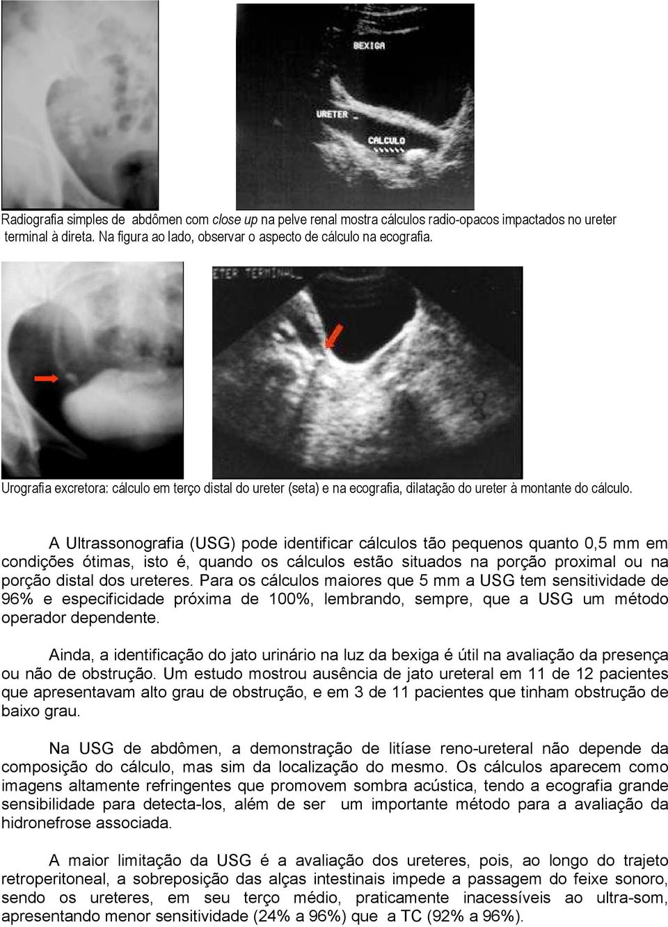 A Ultrassonografia (USG) pode identificar cálculos tão pequenos quanto 0,5 mm em condições ótimas, isto é, quando os cálculos estão situados na porção proximal ou na porção distal dos ureteres.