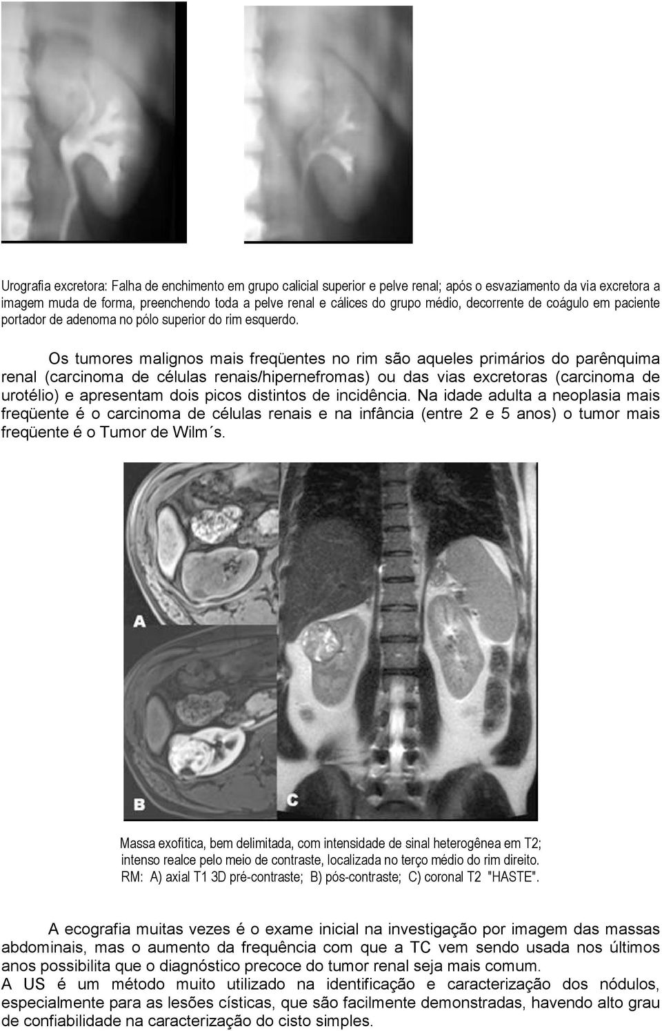 Os tumores malignos mais freqüentes no rim são aqueles primários do parênquima renal (carcinoma de células renais/hipernefromas) ou das vias excretoras (carcinoma de urotélio) e apresentam dois picos