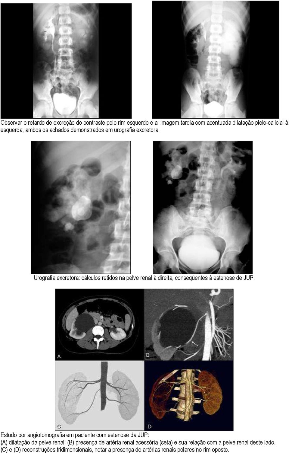 Estudo por angiotomografia em paciente com estenose da JUP: (A) dilatação da pelve renal; (B) presença de artéria renal acessória (seta) e