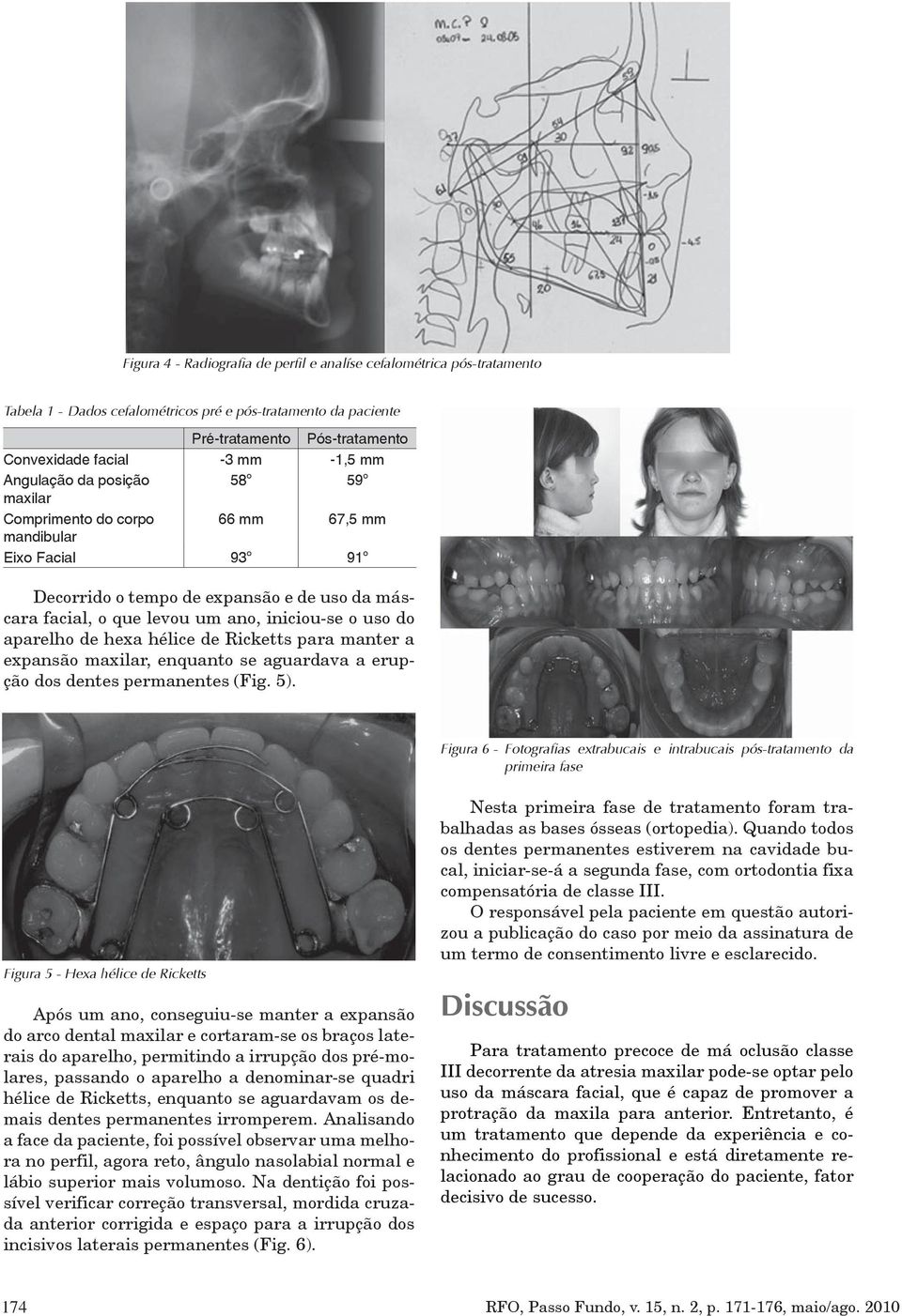 uso do aparelho de hexa hélice de Ricketts para manter a expansão maxilar, enquanto se aguardava a erupção dos dentes permanentes (Fig. 5).