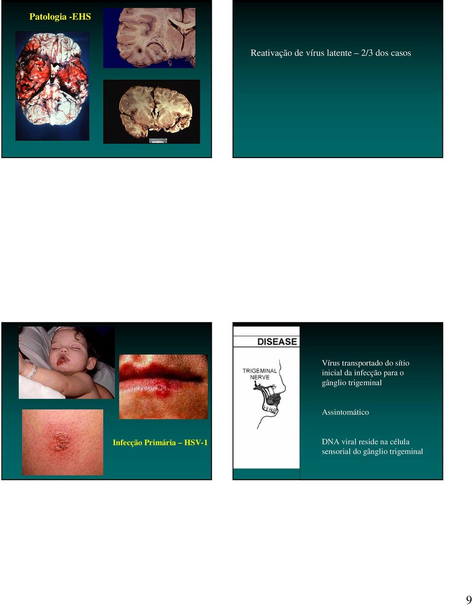 gânglio trigeminal Assintomático Infecção Primária HSV-1