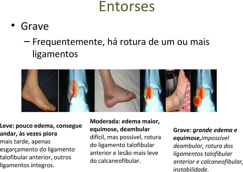 Moderada: edema maior, equimose, deambular difícil, mas possível, rotura do ligamento talofibular anterior e lesão mais