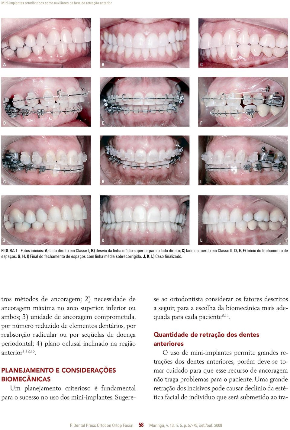 tros métodos de ancoragem; 2) necessidade de ancoragem máxima no arco superior, inferior ou ambos; 3) unidade de ancoragem comprometida, por número reduzido de elementos dentários, por reabsorção