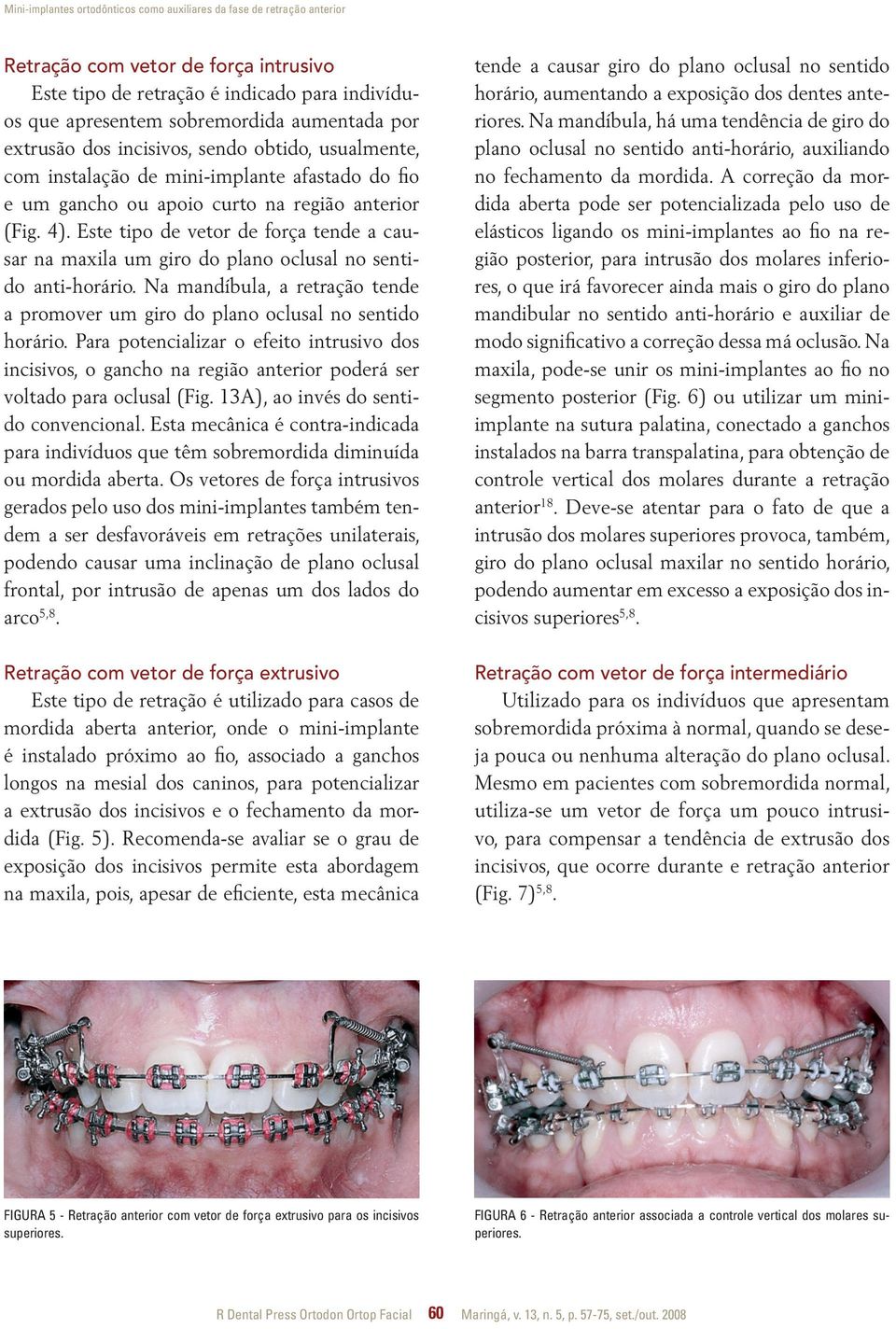 Este tipo de vetor de força tende a causar na maxila um giro do plano oclusal no sentido anti-horário. Na mandíbula, a retração tende a promover um giro do plano oclusal no sentido horário.