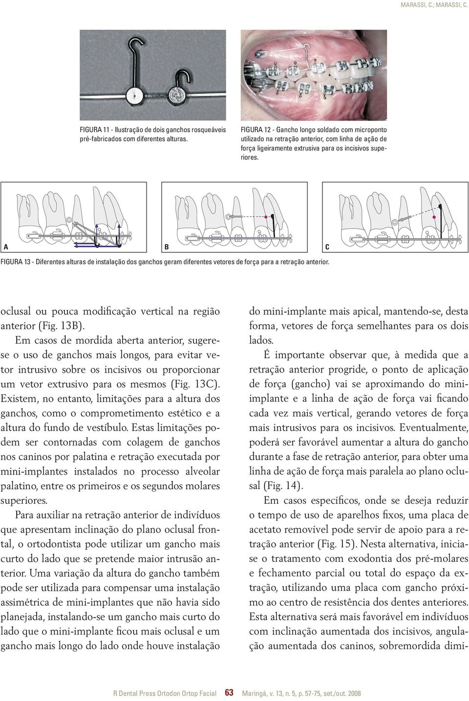 A B C FIGURA 13 - Diferentes alturas de instalação dos ganchos geram diferentes vetores de força para a retração anterior. oclusal ou pouca modificação vertical na região anterior (Fig. 13B).