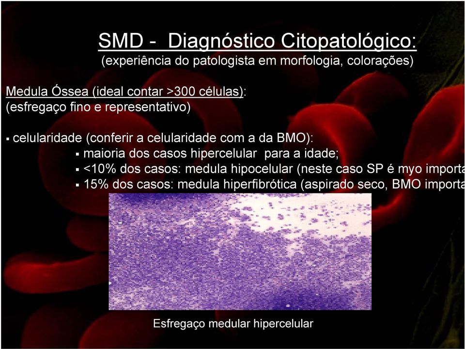 da BMO): maioria i dos casos hipercelular l para a idade; d <10% dos casos: medula hipocelular (neste caso