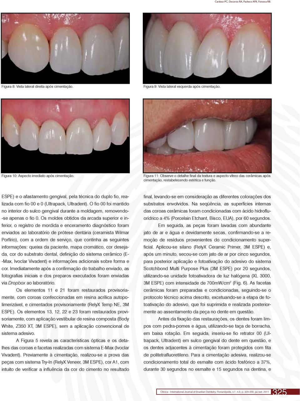 ESPE) e o afastamento gengival, pela técnica do duplo fio, realizada com fio 00 e 0 (Ultrapack, Ultradent).