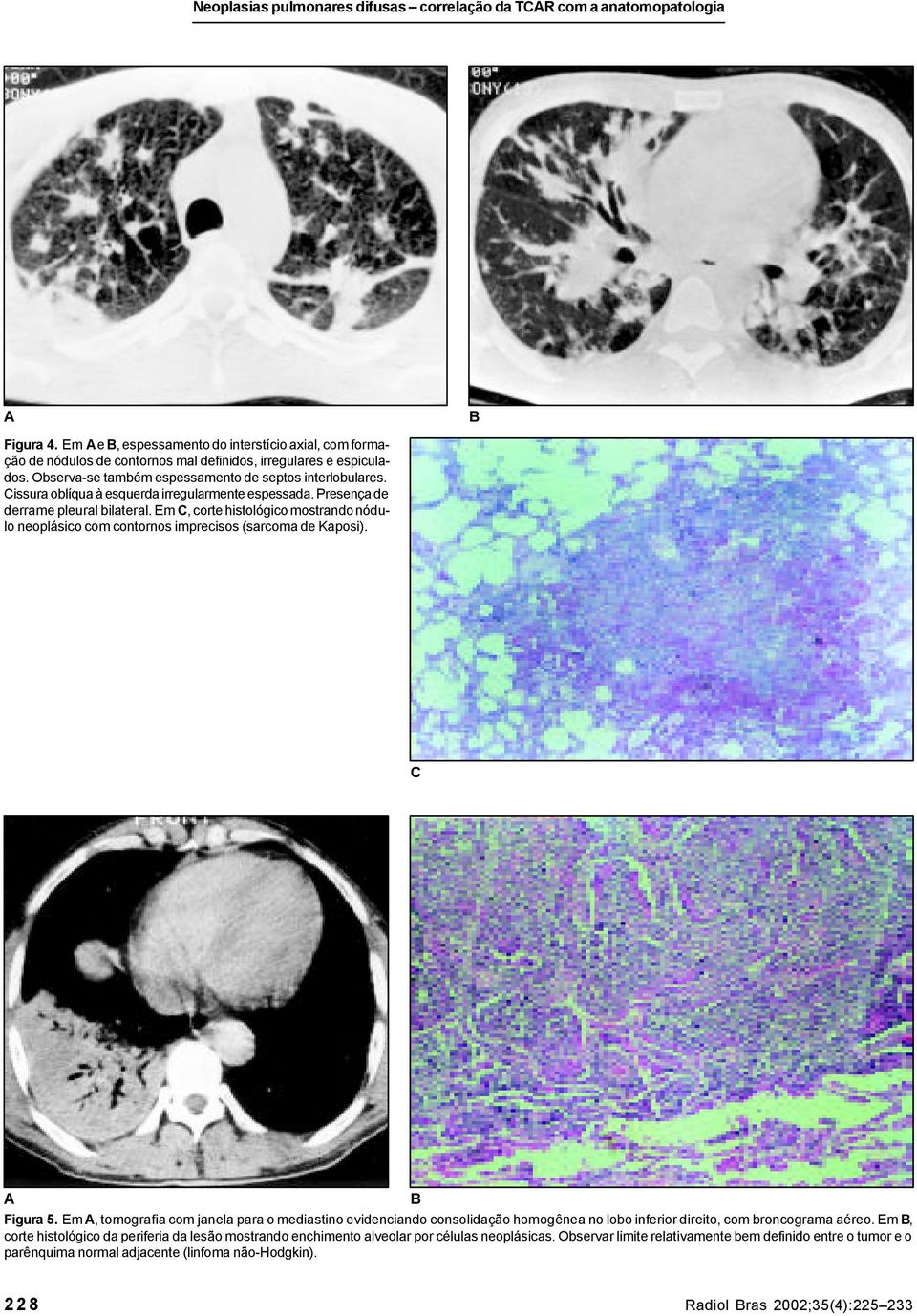 Em, corte histológico mostrando nódulo neoplásico com contornos imprecisos (sarcoma de Kaposi). Figura 5.