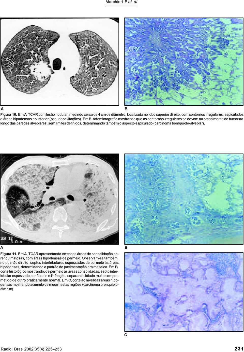 Em, fotomicrografia mostrando que os contornos irregulares se devem ao crescimento do tumor ao longo das paredes alveolares, sem limites definidos, determinando também o aspecto espiculado (carcinoma