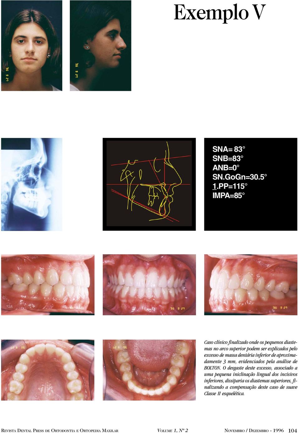 excesso de massa dentária inferior de aproximadamente 3 mm, evidenciados pela análise de BOLTON.