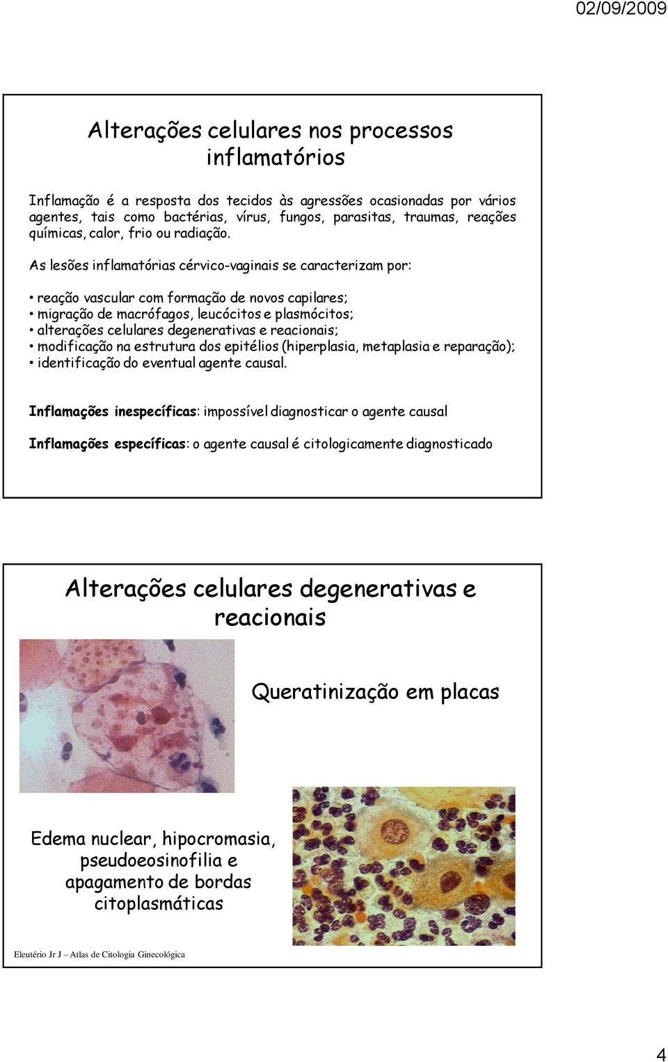 As lesões inflamatórias cérvico-vaginais se caracterizam por: reação vascular com formação de novos capilares; migração de macrófagos, leucócitos e plasmócitos; alterações celulares degenerativas e