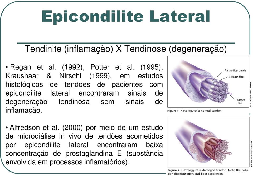 sinais de degeneração tendinosa sem sinais de inflamação. Alfredson et al.