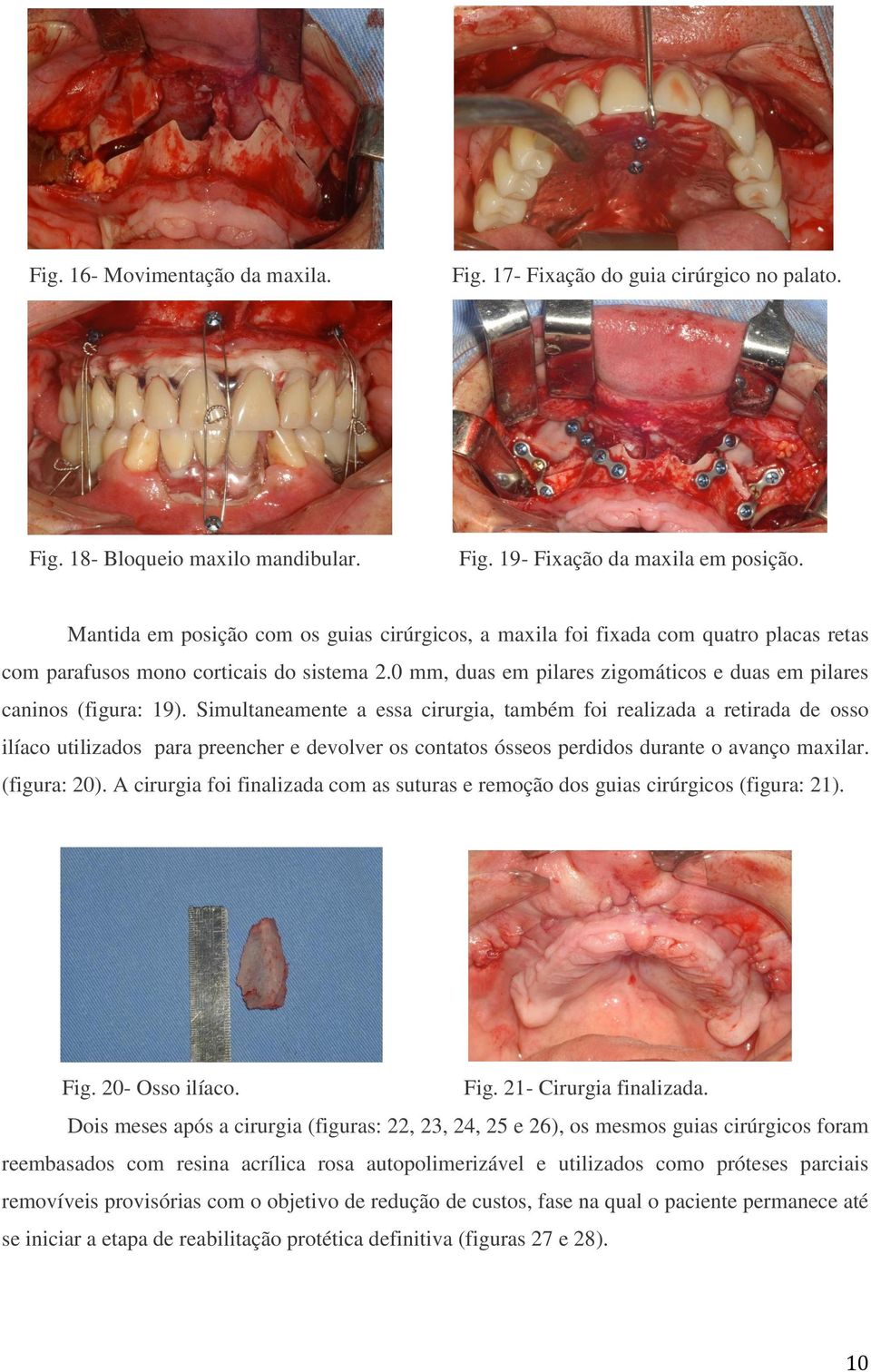 0 mm, duas em pilares zigomáticos e duas em pilares caninos (figura: 19).