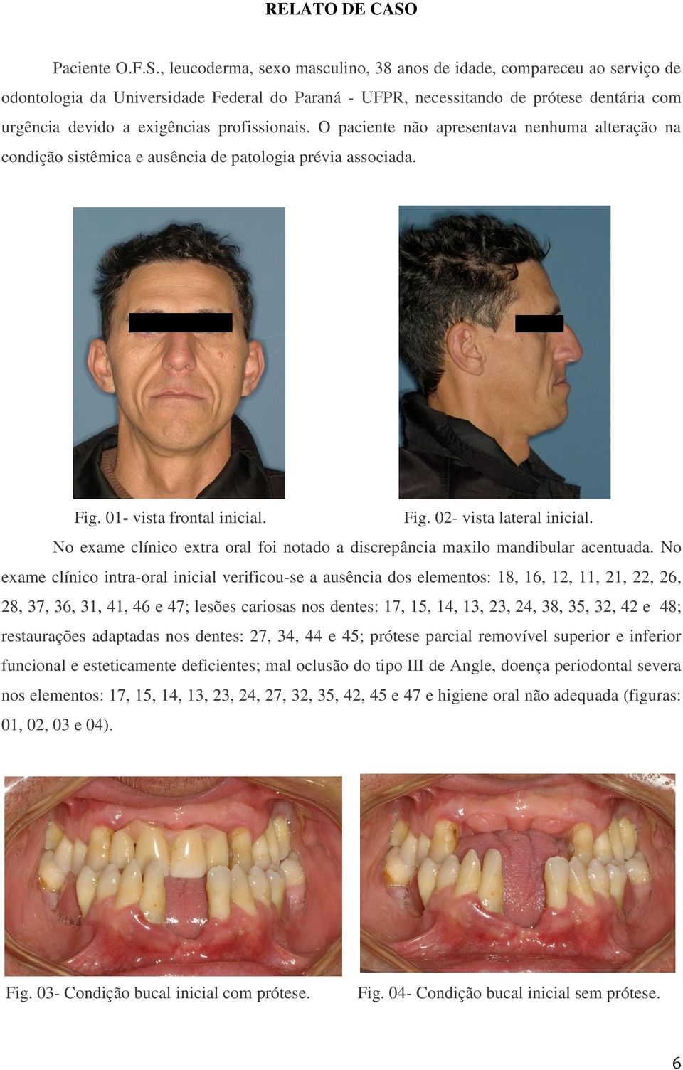 , leucoderma, sexo masculino, 38 anos de idade, compareceu ao serviço de odontologia da Universidade Federal do Paraná - UFPR, necessitando de prótese dentária com urgência devido a exigências