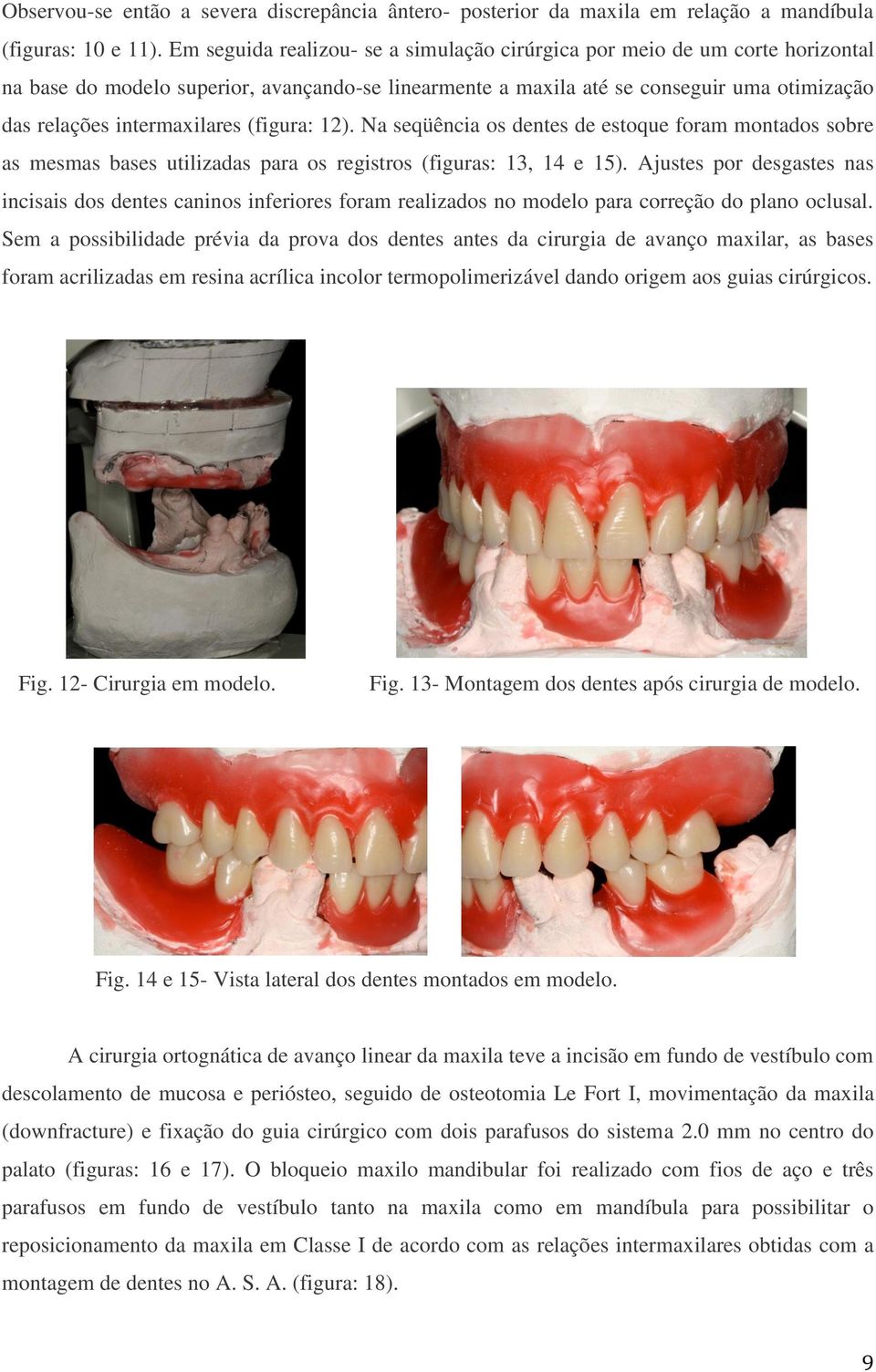 (figura: 12). Na seqüência os dentes de estoque foram montados sobre as mesmas bases utilizadas para os registros (figuras: 13, 14 e 15).