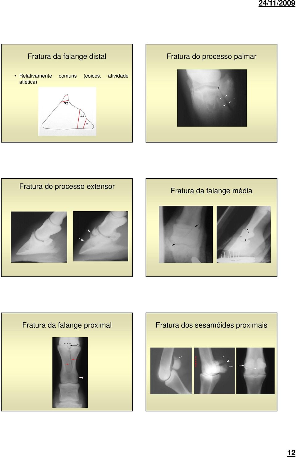 Fratura do processo extensor Fratura da falange média