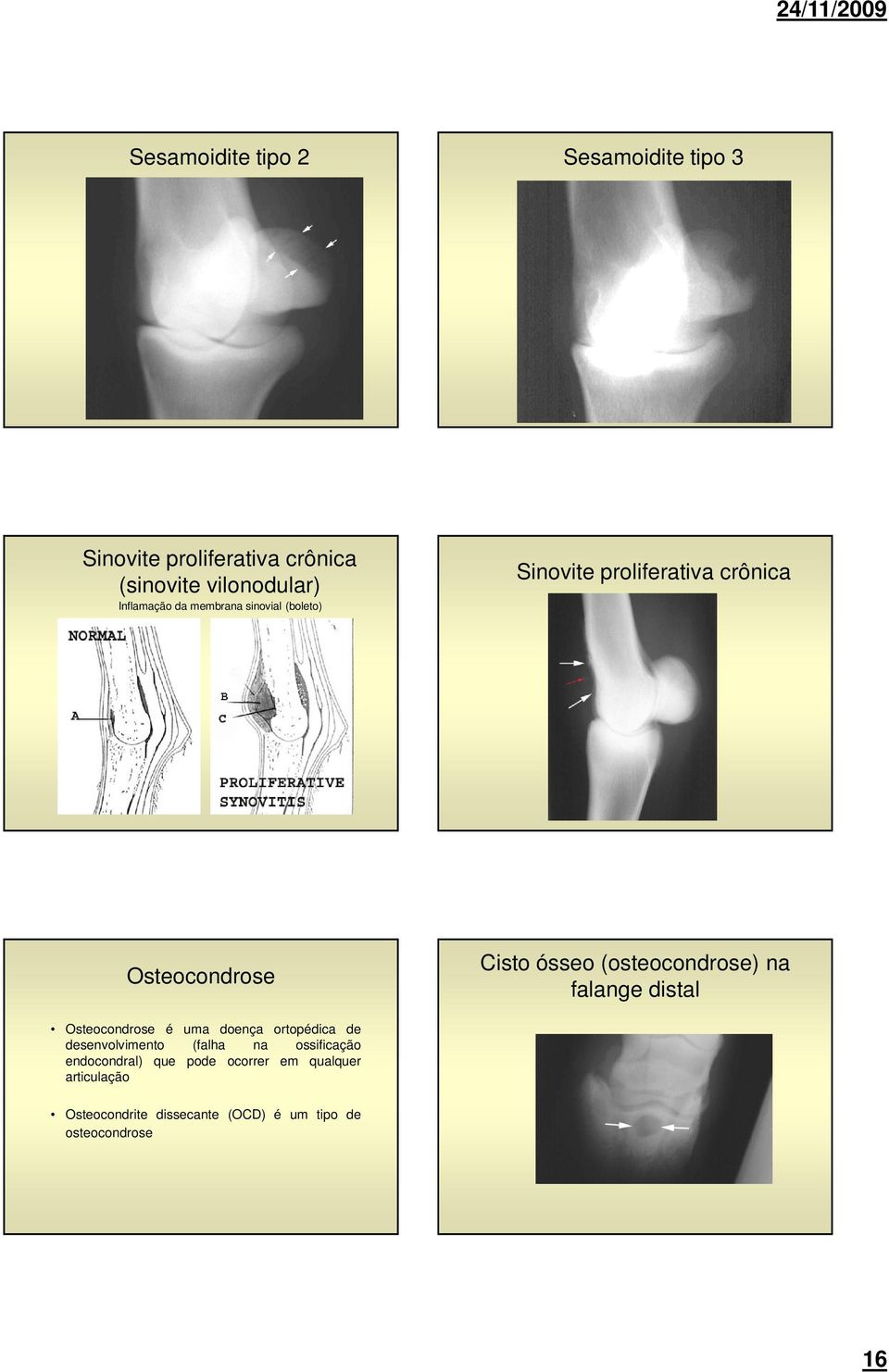 na falange distal Osteocondrose é uma doença ortopédica de desenvolvimento (falha na ossificação